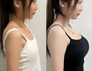 ​赤峰刘星赫院长丰胸微整案例_自体脂肪隆乳真实效果