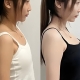 ​赤峰刘星赫院长丰胸微整案例_自体脂肪隆乳真实效果