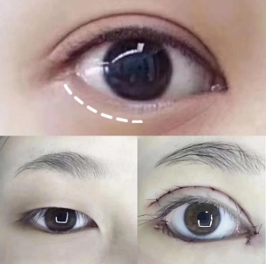 下眼睑下至术前后对比图