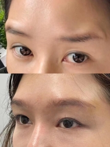 膨体隆眉弓前后对比图