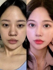 鼻部膨体假体取出前后对比图