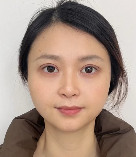 双眼皮整形之后