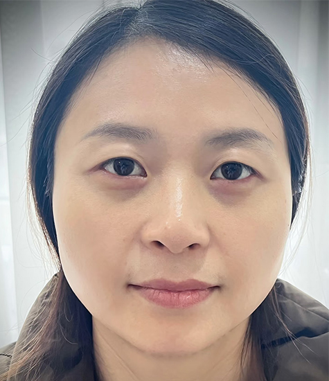 双眼皮整形之前