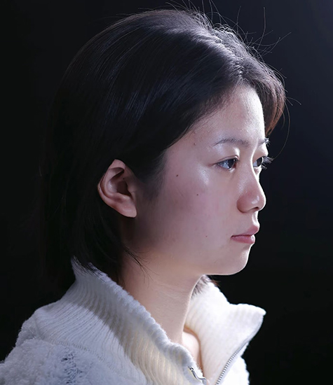 隆鼻整形手术之前