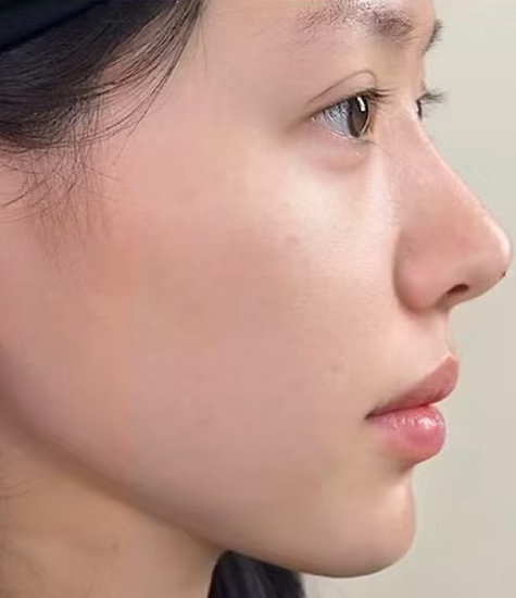 面部整形手术之后