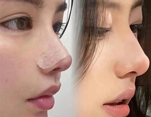 刘星赫肋软骨鼻综合整形案例：95 后女生的蜕变之旅