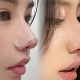 刘星赫肋软骨鼻综合整形案例：95 后女生的蜕变之旅