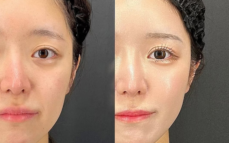 双眼皮案例