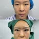 刘星赫院长双眼皮案例