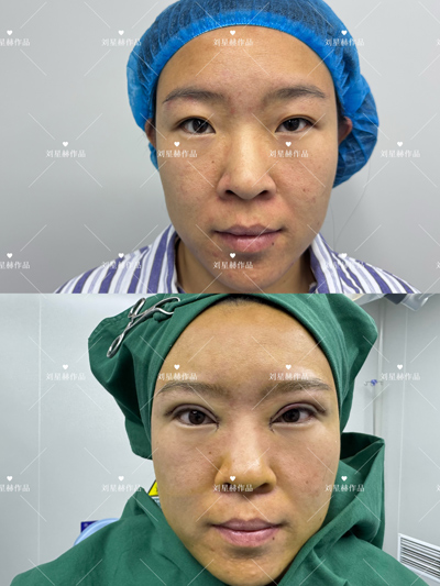 刘星赫院长双眼皮案例