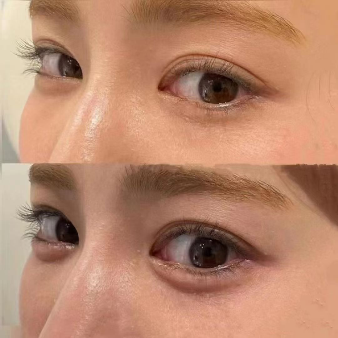 赤峰松山德康刘星赫院长卧蚕打造真人对比案例 赤峰松山德康刘星赫院长卧蚕打造真人对比案例